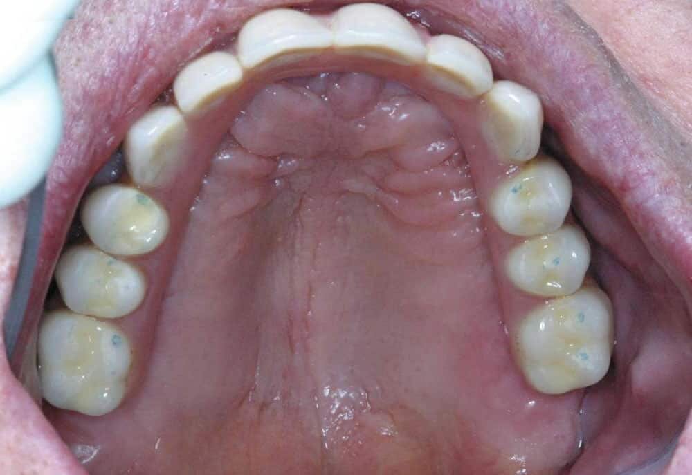 Traditional dentures vs teeth implants
